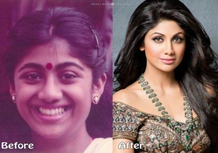 TOP 10 Plastic Surgeries FAIL of Bollywood actors- See Pics  